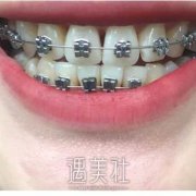 美国3M金属超薄托槽矫正果好吗? width=