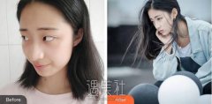 打注射瘦脸前后果图对比 width=