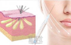 自体脂肪填充几天能恢复? width=