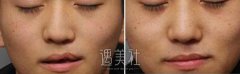 老公有唇腭裂会遗传吗? width=