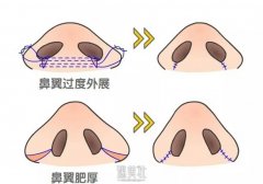 鼻头缩小术用什么方法? width=