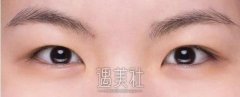 肿眼泡适合割双眼皮吗?求解 width=