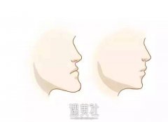 假性地包天要怎样矫正?假性地包天矫正麻烦吗? width=