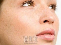 咖啡斑能吗 width=