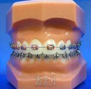美国3M金属超薄托槽矫正适应症状 width=