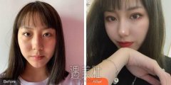 上海九院王涛做的鼻子和张余光做的鼻子多方位对比~ width=