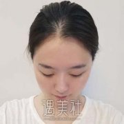 北京生物焊接双眼皮哪家好？看我做了之后差点爱上自己！ width=