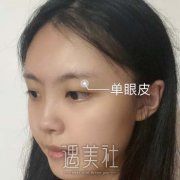 北京双眼皮修复三个月眼睛就变大了呢，敲好看喔 width=