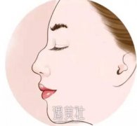 驼峰鼻修复价格贵不贵?刚出身社会的小白阔以做的起吗? width=