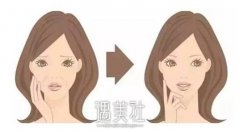 额头除皱术有哪些方法呢?额头除皱术有哪些注意事项呢? width=