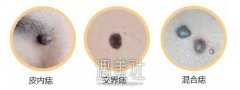 冷冻去痣价格这么低靠不靠谱?还有更好的选择吗? width=
