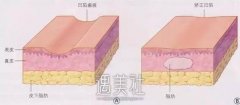 公立整形医院做自体脂肪填充靠谱吗？ width=