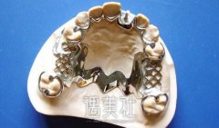 烤瓷牙有哪些种类?哪种烤瓷牙比较好? width=