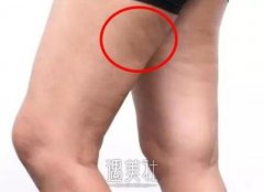 红色肥胖纹瘦了会消失吗?有哪些方法推荐? width=