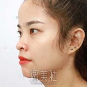 埋线双眼皮和隆鼻美丽套餐，丑丑的蚕蛹化身为漂亮蝴蝶！ width=