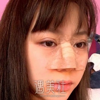 驼峰鼻矫正告诉你鼻子是怎样决定颜值的，爸妈都惊讶了… width=