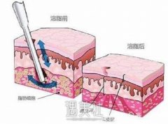 激光溶脂和吸脂的区别，扒一扒这两者的相似和差别 width=