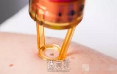 昆明第一医科大学附属医院做激光去痣多少钱?普通上班族可以做的起吗 width=
