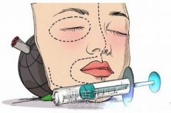 隆鼻手术没问题么？可以做些什么让隆鼻的没问题性提高？ width=