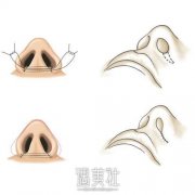 缩小鼻头的方法有哪些?什么方式是比较好的缩小鼻头的办法? width=