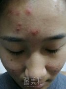 青少年痤疮引发的原因是什么?该如何调节? width=