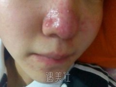 酒糟鼻整形术有哪些方法呢?一般多久可以恢复? width=