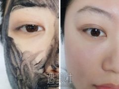 黑脸娃娃手术价格贵吗？有什么优点？要做几次？ width=
