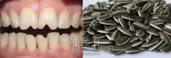 瓜子牙怎么修复?修复需要多少钱? width=