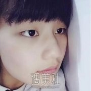 刚做了双眼皮的图片是不是有点吓人？一个月就恢复好了！ width=