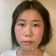 全切双眼皮7天-15天恢复图，颜值蹭蹭往上涨！ width=