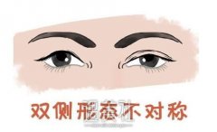 双眼皮失败的八种图片，看看双眼皮手术失败了吗？ width=