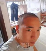 大麦微针植发6000单位果图，头发浓密的秘诀~ width=