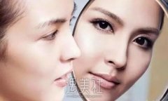 v美减龄果好吗？v美减龄面部提升术是怎样的做法？ width=
