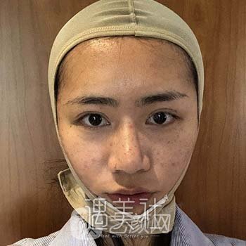 去颊脂垫果前后对比图：76天彻底解决大脸问题 width=