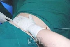 腹部吸脂整形价格大概是多少？手术前后对比图片一览 width=