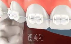 洗牙有好处吗？以下几点可以参考 width=