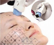 夏季适合进行像热玛吉这样的医学美容项目吗？ width=