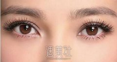 韩式三点双眼皮后要多长时间恢复呢？ width=