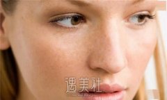 怎样去脸上的色斑？常见医美方法为你分享 width=