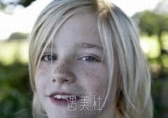 如何可以消除雀斑呢？哪种方法好呢？ width=