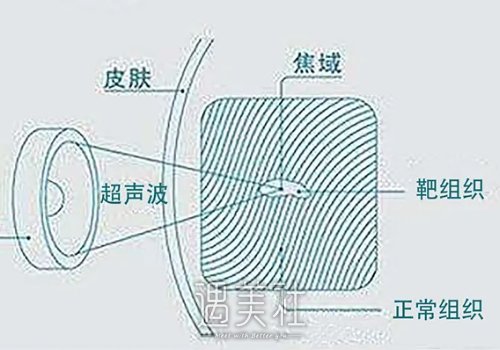 黄金超声炮抗衰效果怎么样？有哪些优势？ width=