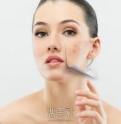 激光祛斑色脱是什么意思？有没有副作用呢？ width=