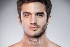 胡须移植的方法和注意事项分别有哪些？ width=