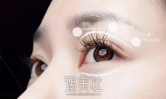 埋线双眼皮好不好？这个问题需要从多个角度来回答 width=