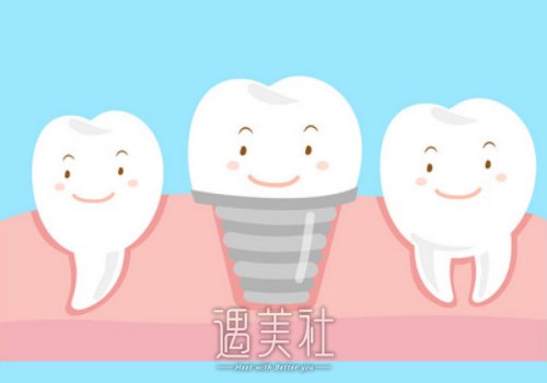 美国百康种植体多少钱一颗？都有哪些型号？ width=