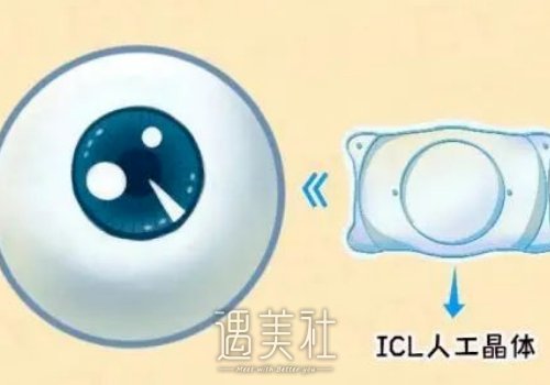 prl晶体植入与icl的区别有哪些？各自优势汇总一览 width=