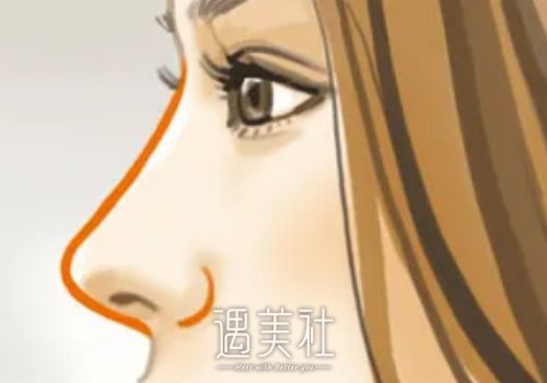人工骨是什么材料做的？填充后会吸收吗？ width=