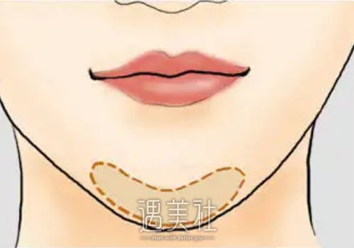 假体垫下巴的危害和后遗症有哪些？可以管一辈子吗？ width=