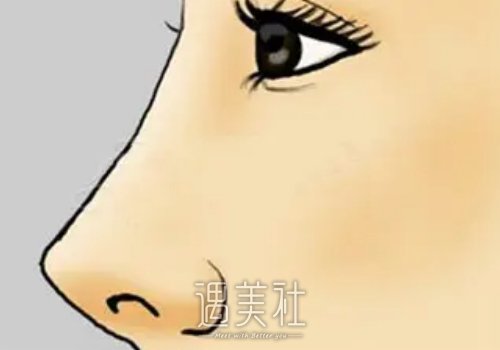 生物肋骨鼻多少钱一支？和玻尿酸有什么区别？ width=