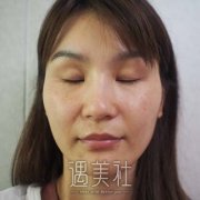 肿泡眼双眼皮术后图片，手术前后一个月对比案例展示 width=